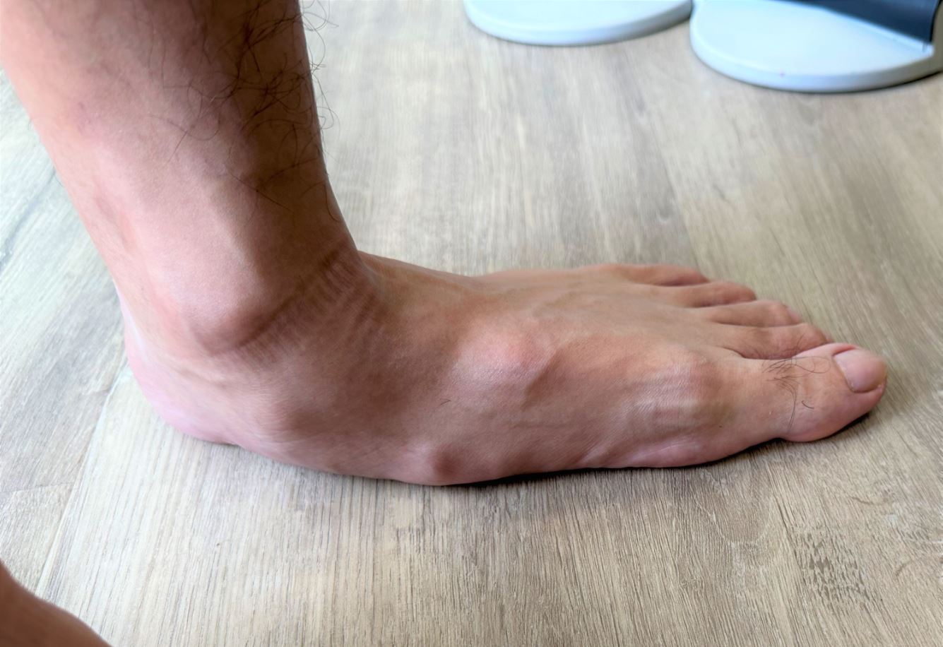 Signs and symptoms of flat feet (pes planus).