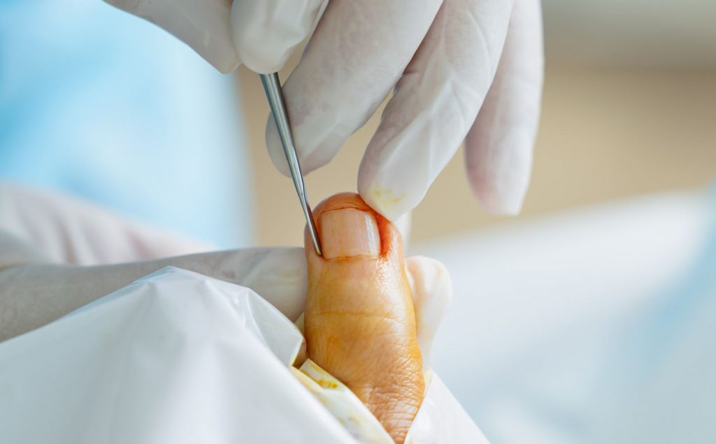 ingrown toenail treatment and removal by podiatrist in Singapore