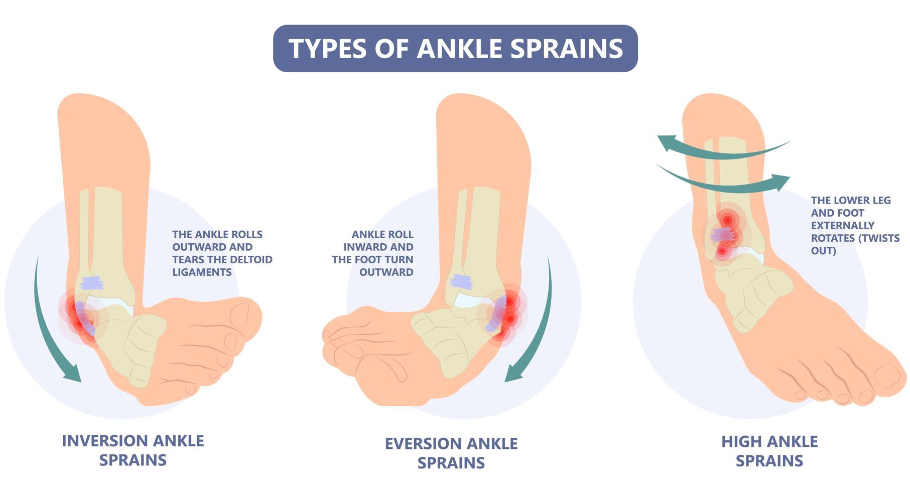 acute-ankle-sprain-causes-management-straits-podiatry