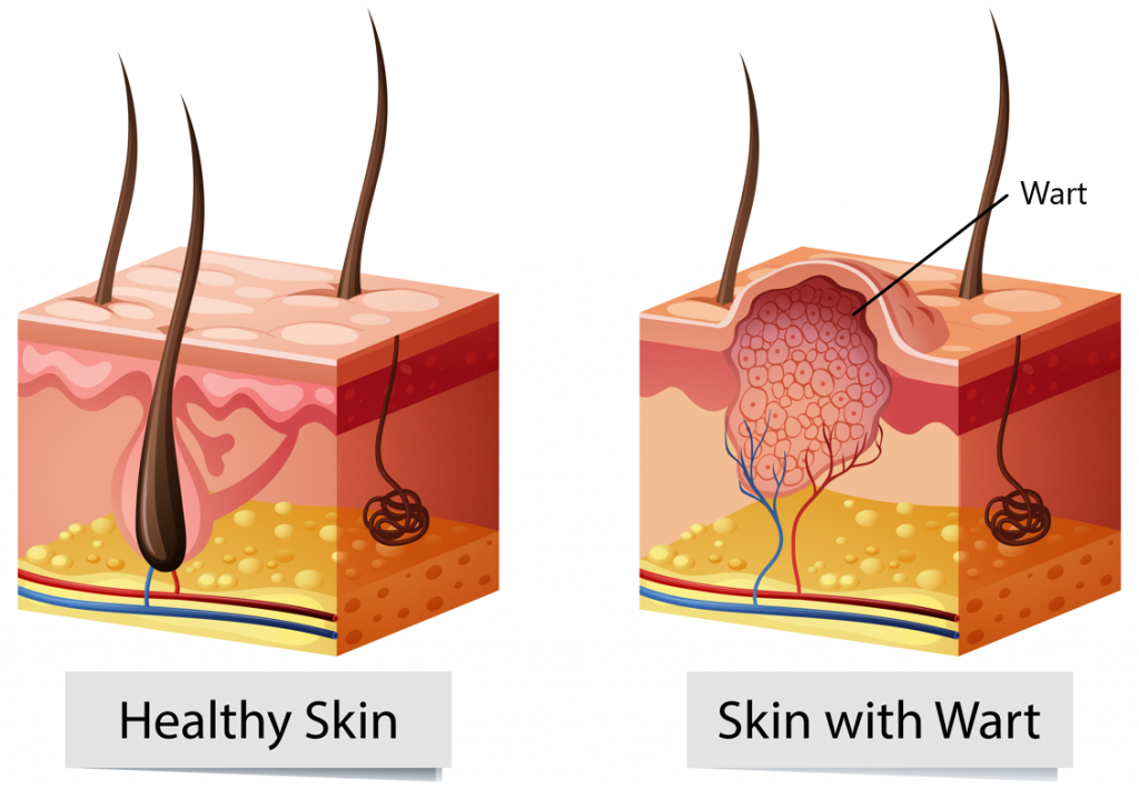 Apakah ketuat plantar? - Straits Podiatry Singapura