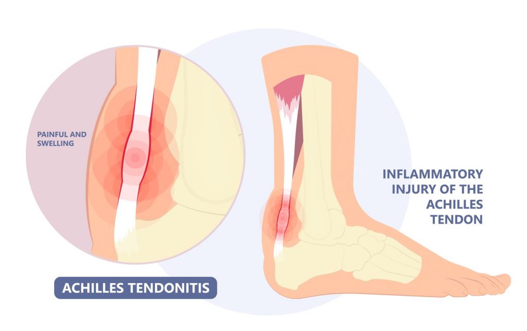 Achilles tendonitis explained.
