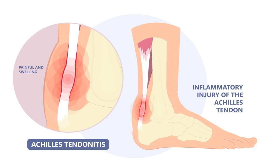 Rawatan tendonitis Achilles di SIngapore. Foto yang menunjukkan anatomi tendon achilles dan di mana tendon meradang. Straits Podiatry di Singapura.