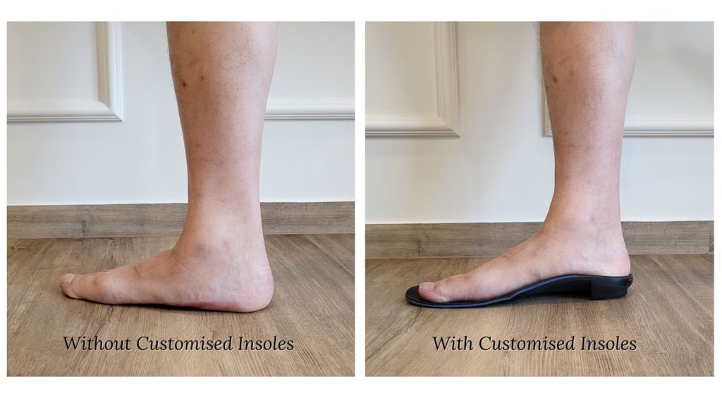 Rawatan kaki rata dengan insole yang disesuaikan.