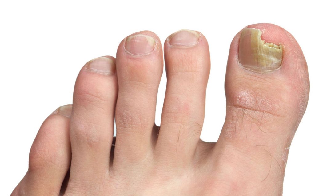Fungal nail infection in Singapore. Fungal nail treatment at Straits Podiatry