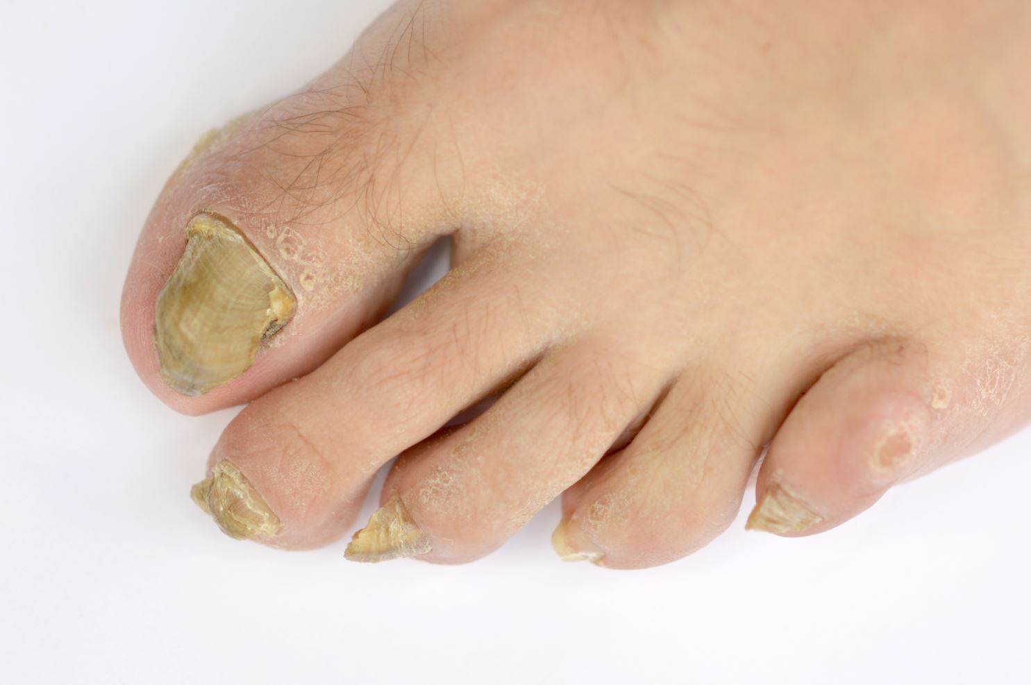 Signs and symptoms of fungal nail infection. Yellow discoloured nails. Straits Podiatry