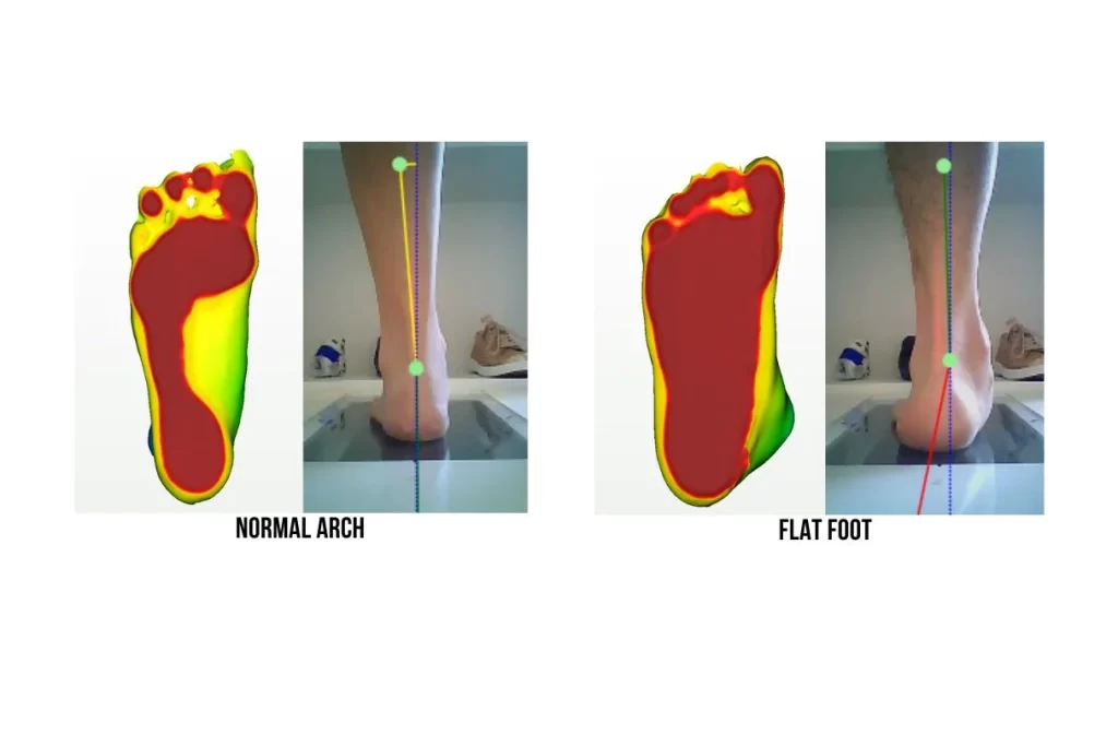 Flat Feet Pes Planus Causes Symptoms Management Straits Podiatry