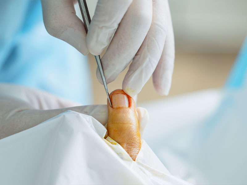 Ingrown Toenail Treatment in Singapore.