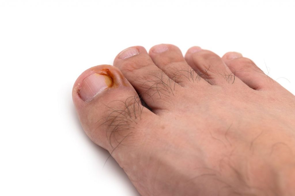 Ingrown Toenail in Singapore, signs and symptoms - Straits Podiatry Singapore.