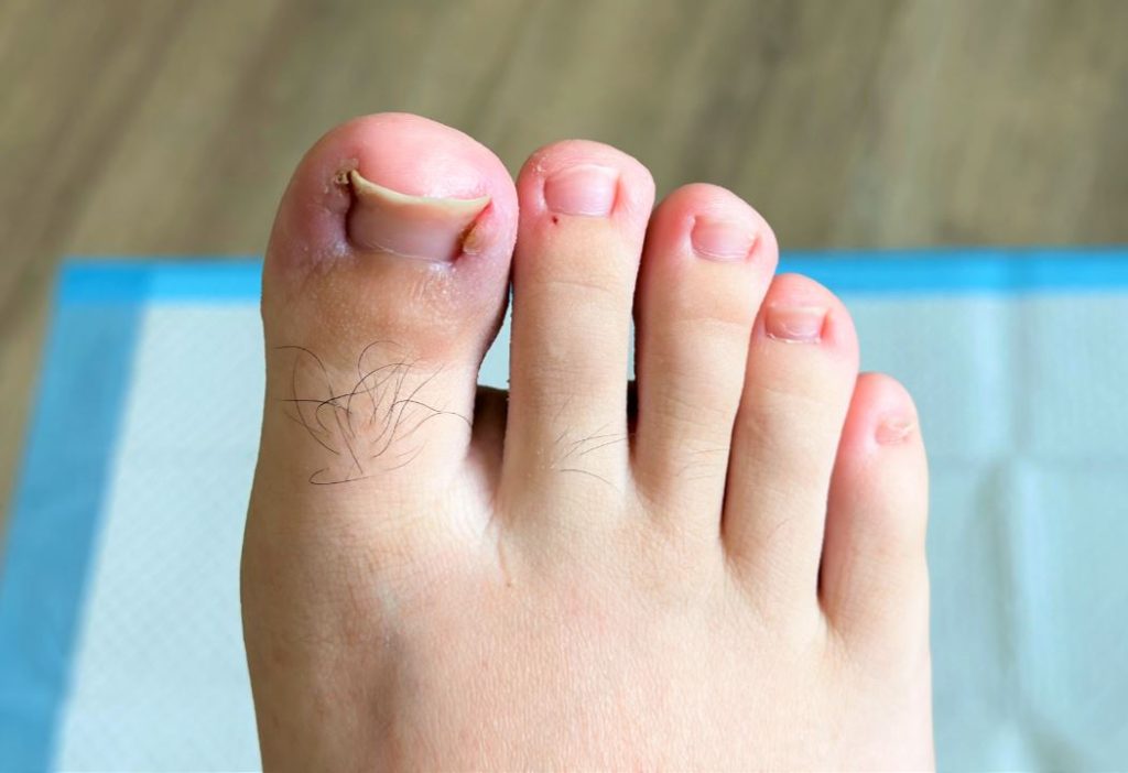 signs and symptoms of ingrown toenail