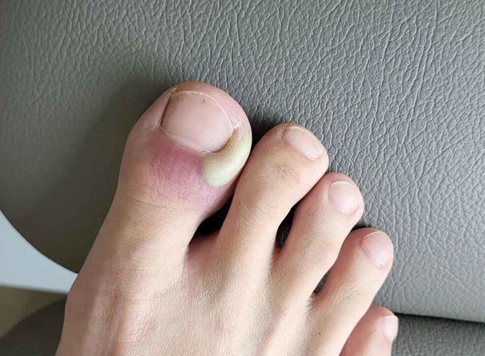 Infected ingrown toenail with pus requiring nail surgery treatment