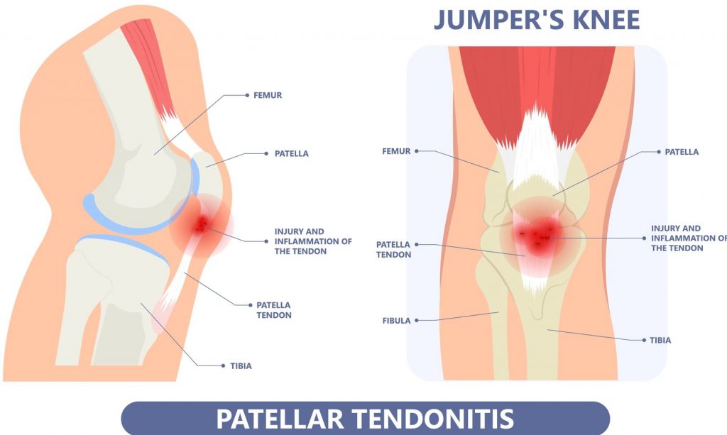 Apakah lutut jumper? Apakah tendonitis patellar? Straits Podiatry