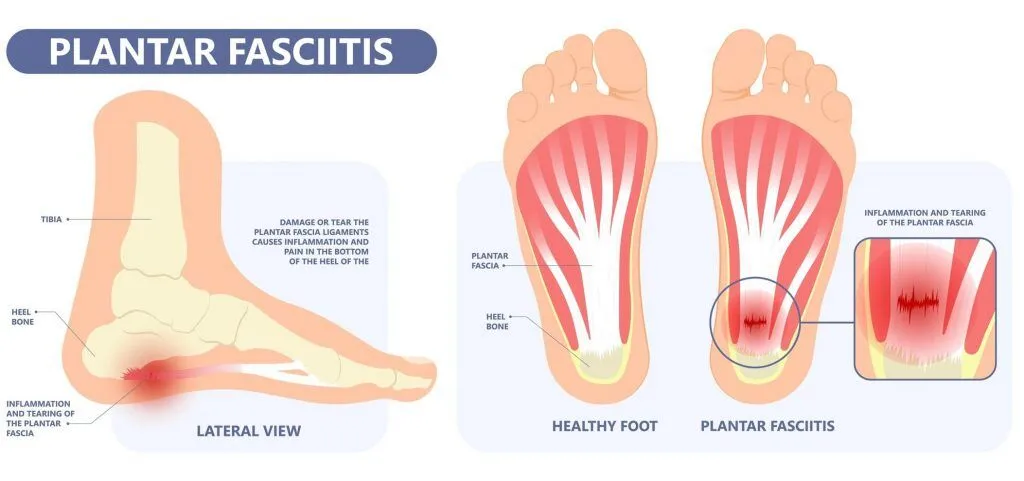 illustration showing anatomy and causes of plantar fasciitis