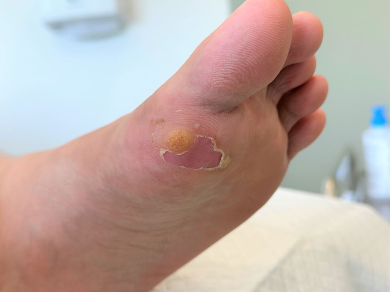 Signs and symptoms of plantar wart - Straits Podiatry Singapore