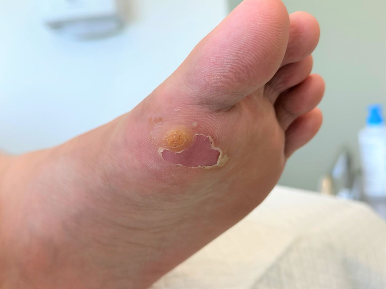 Tanda dan gejala ketuat plantar - Straits Podiatry Singapura