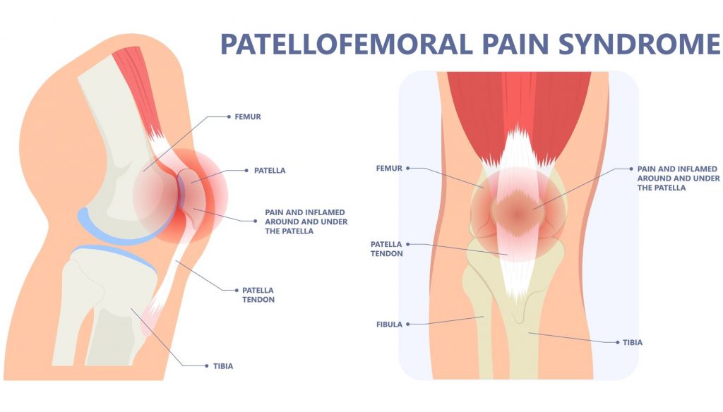 什么是跑步者膝关节或髌股关节疼痛综合症？