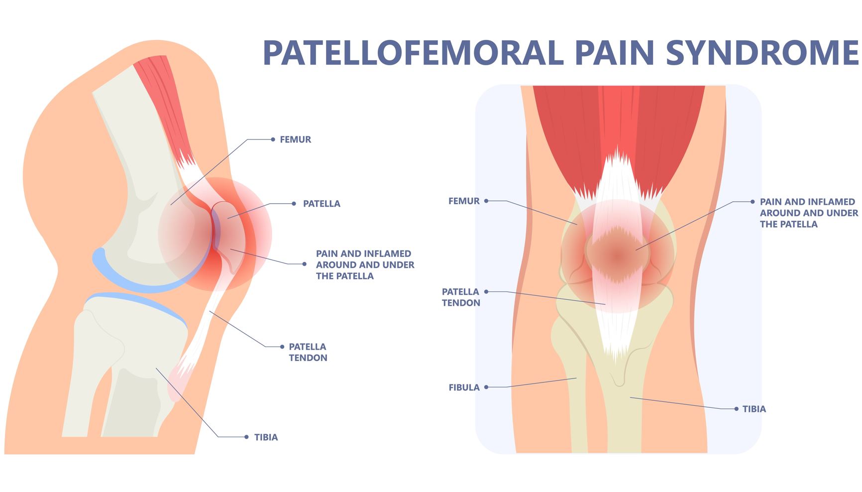 Runner’s Knee (Patellofemoral Pain Syndrome) Straits Podiatry