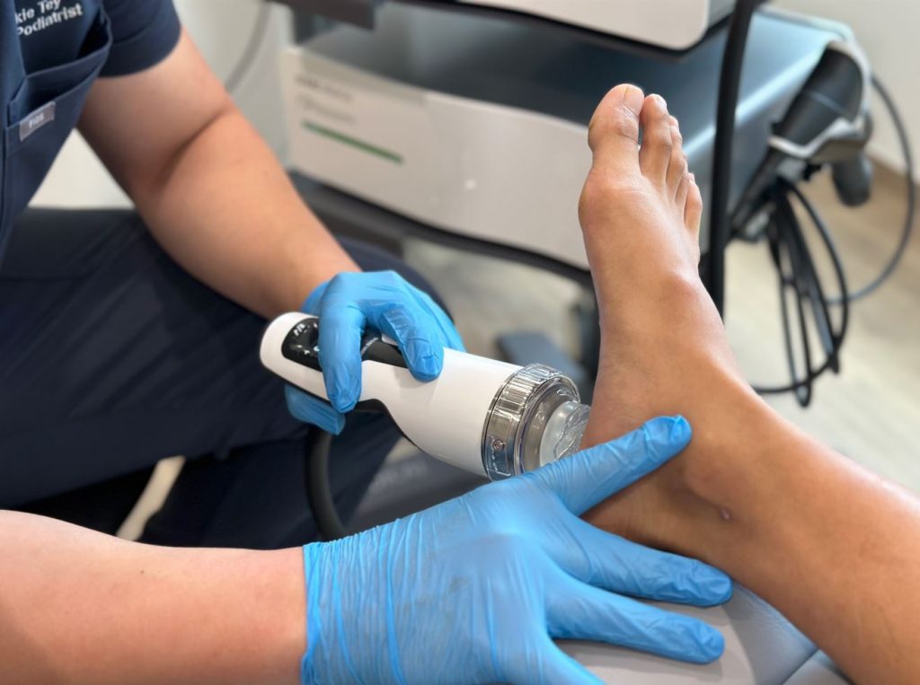 plantar fasciitis treatment in Singapore by podiatrist using shockwave therapy