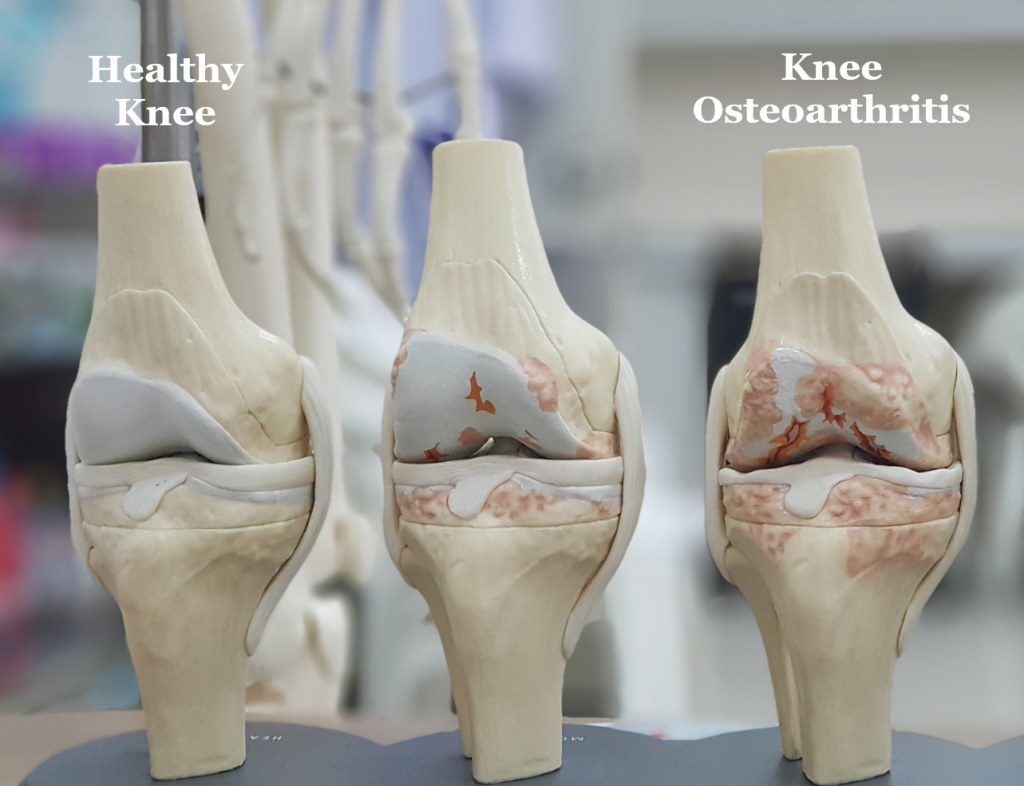 Apakah osteoartritis lutut? Straits Podiatry