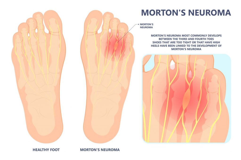 Apa itu Neuroma? Apa itu Neuroma Morton? Straits Podiatry