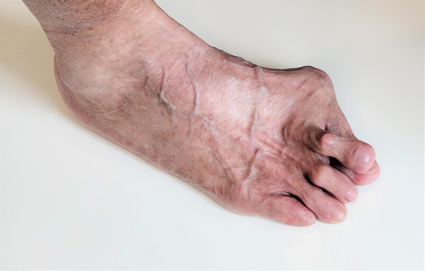 Tanda dan gejala bunions. Tanda-tanda hallux valgus. Straits Podiatry