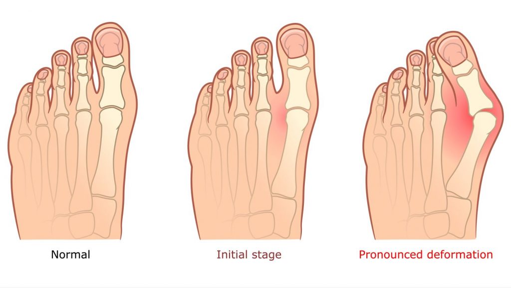 What is a bunion? Stages of bunions. Straits Podiatry