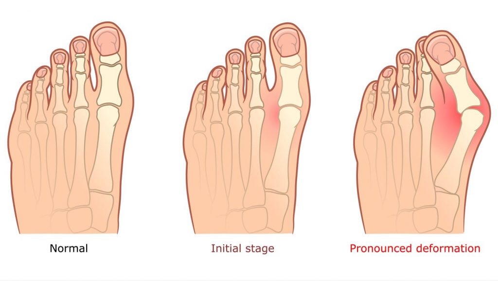 Apa itu bunion? Peringkat penyatuan. Straits Podiatry