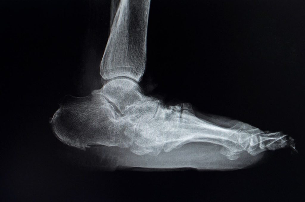 显示骨骼和关节骨折和脱位的夏科氏足 X 光片。