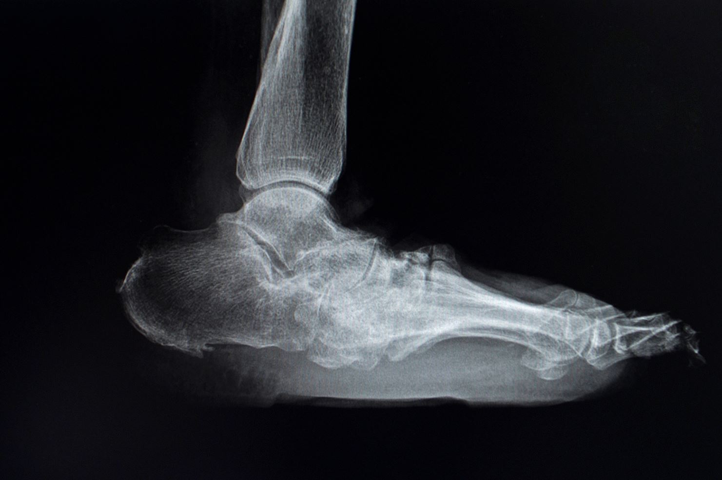 Charcot's Foot X-ray showing fractures and dislocation of the bones and joints.