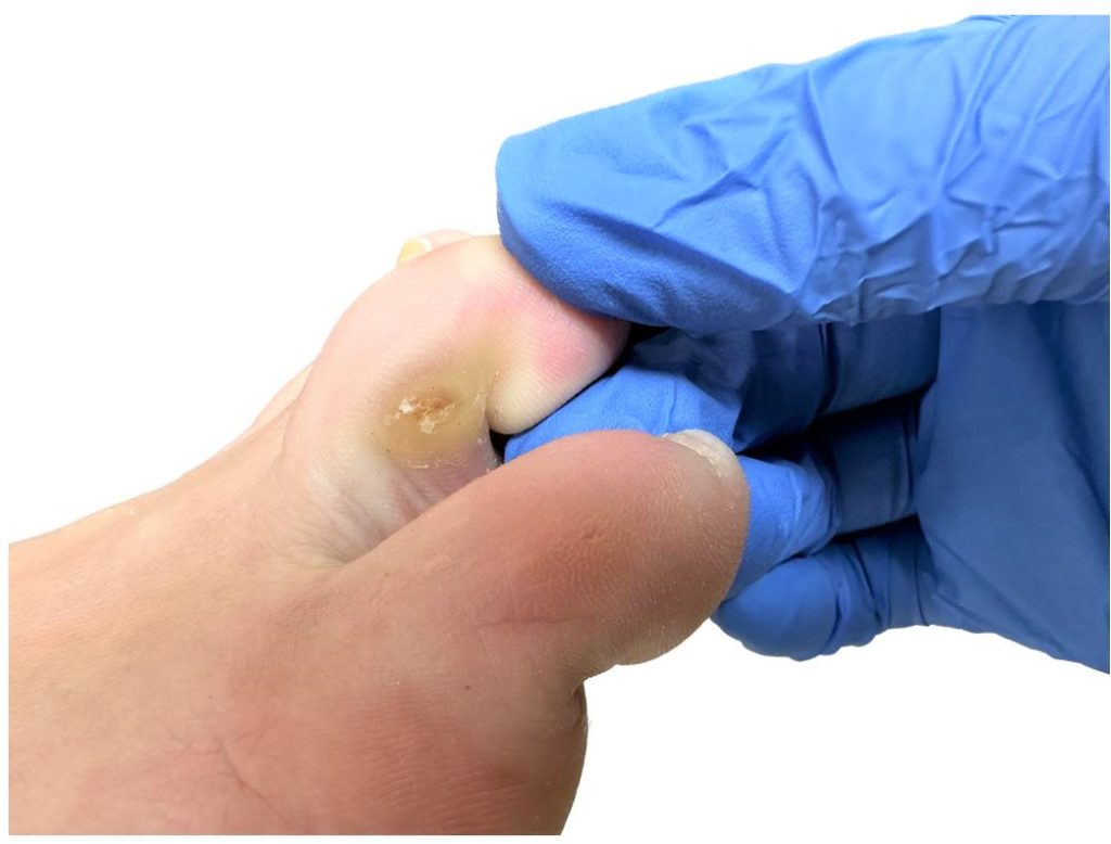 patient with corns in between toes on foot