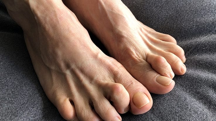 Signs and symptoms of Clawed Toes. Straits Podiatry Singapore