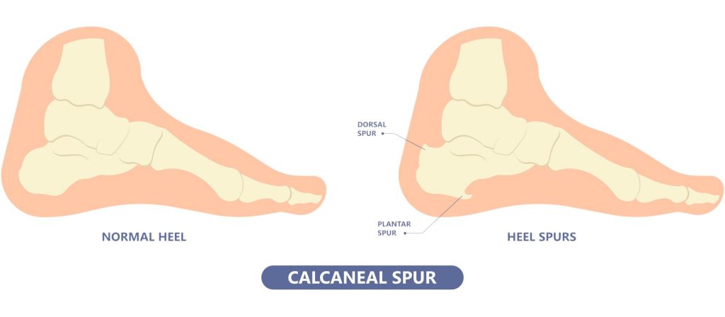 What is heel spur? Straits Podiatry