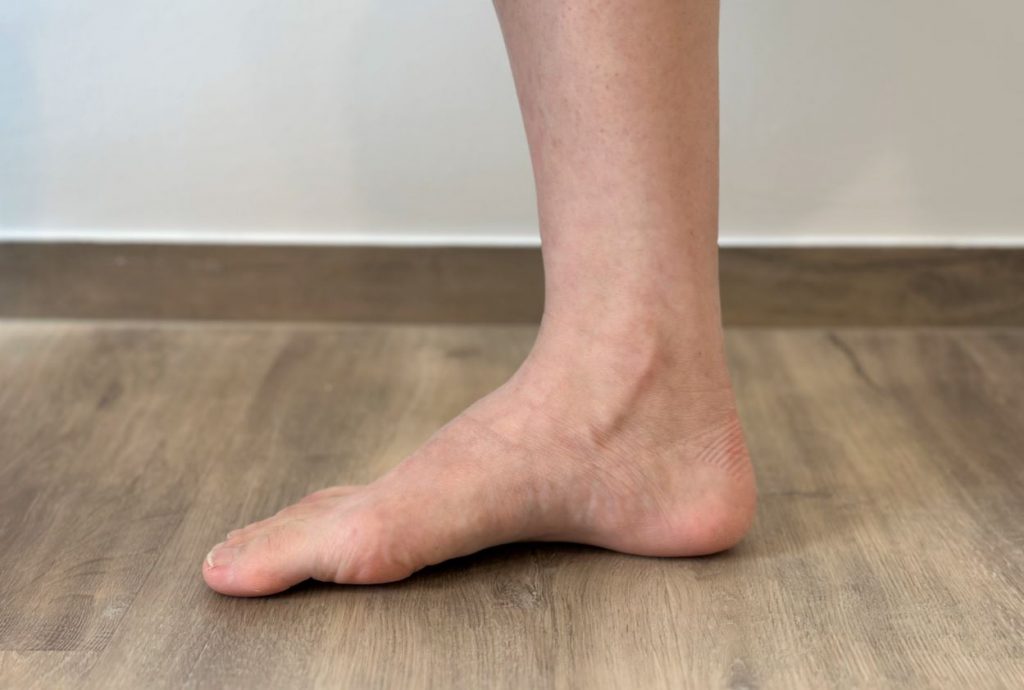 Apakah Kaki Gerbang Tinggi? Apa itu Pes Cavus? Straits Podiatry