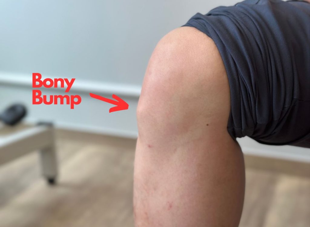 Osgood-Schlatter disease causes bony bump at knee.