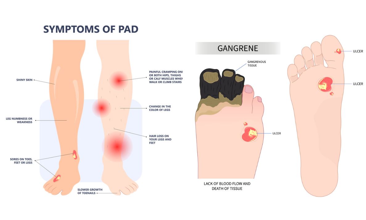 Peripheral Arterial Disease in Singapore Straits Podiatry