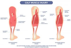 Calf Strain Management in Singapore - Straits Podiatry