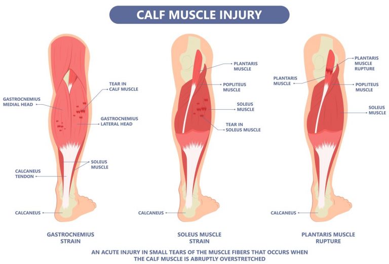 calf-strain-management-in-singapore-straits-podiatry