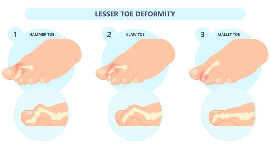 What are Clawed and Hammer Toes? What are the types of toe deformities? Straits Podiatry Singapore