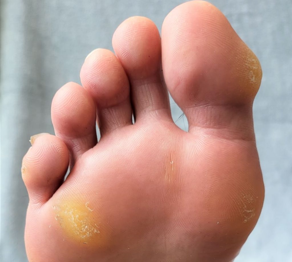 image of foot sole corn and calluses