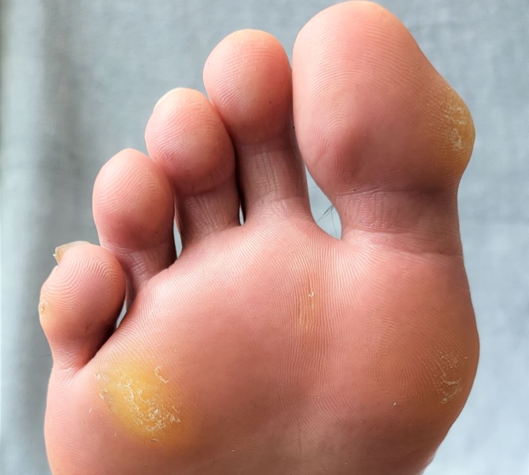 What are corns and calluses? Straits Podiatry Singapore.