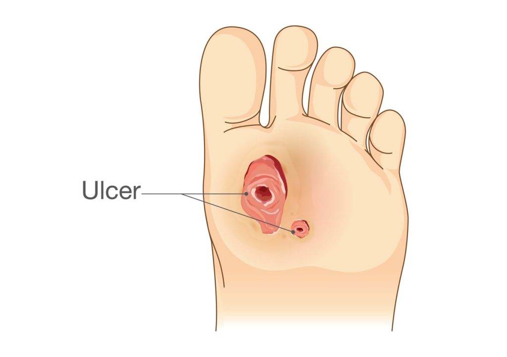 Apakah ulser kaki diabetik? Straits Podiatry Singapura