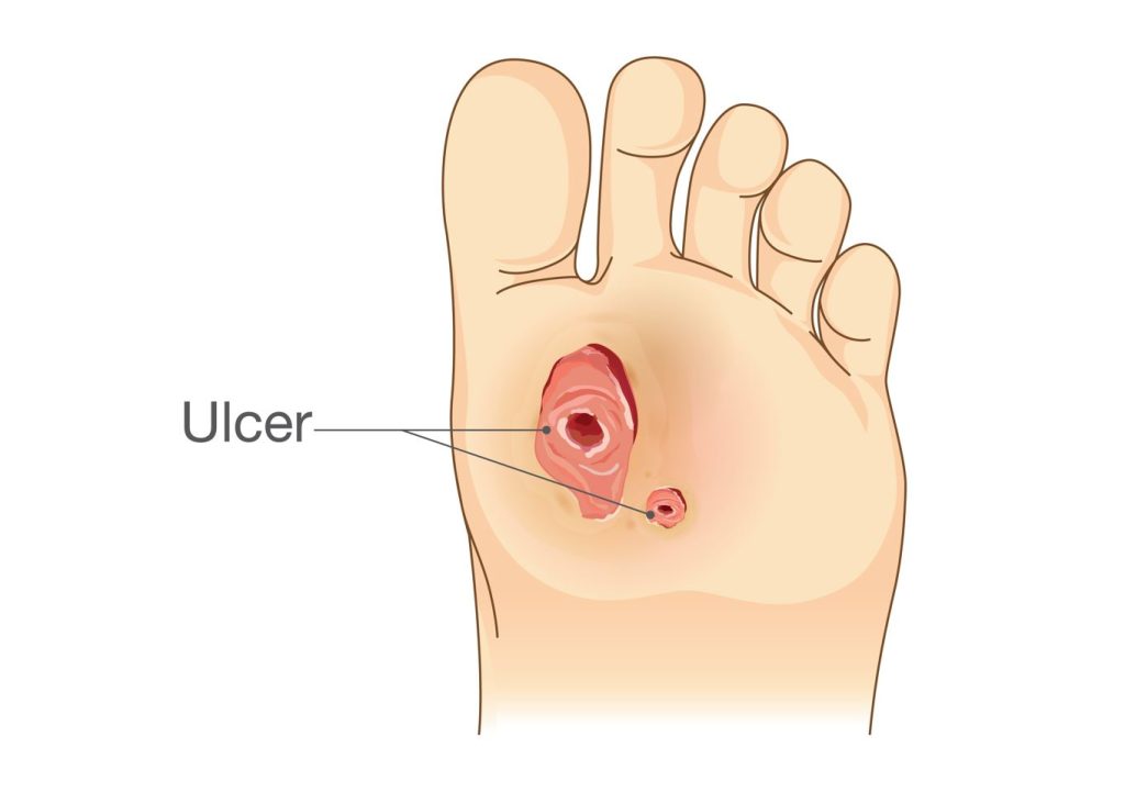 什么是糖尿病足溃疡？新加坡海峡足病诊疗中心