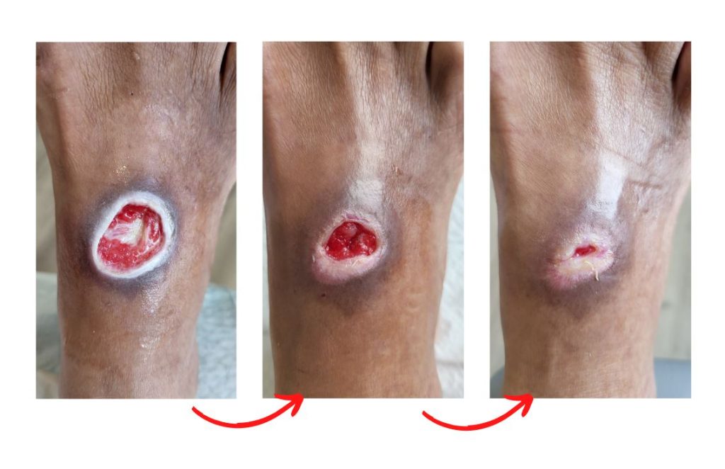Rawatan ulser kaki diabetes dan luka di Singapura.