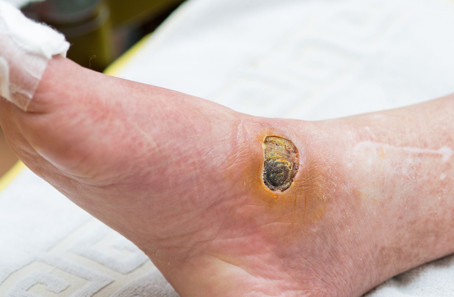 Diabetic foot ulcer and wounds in Singapore.