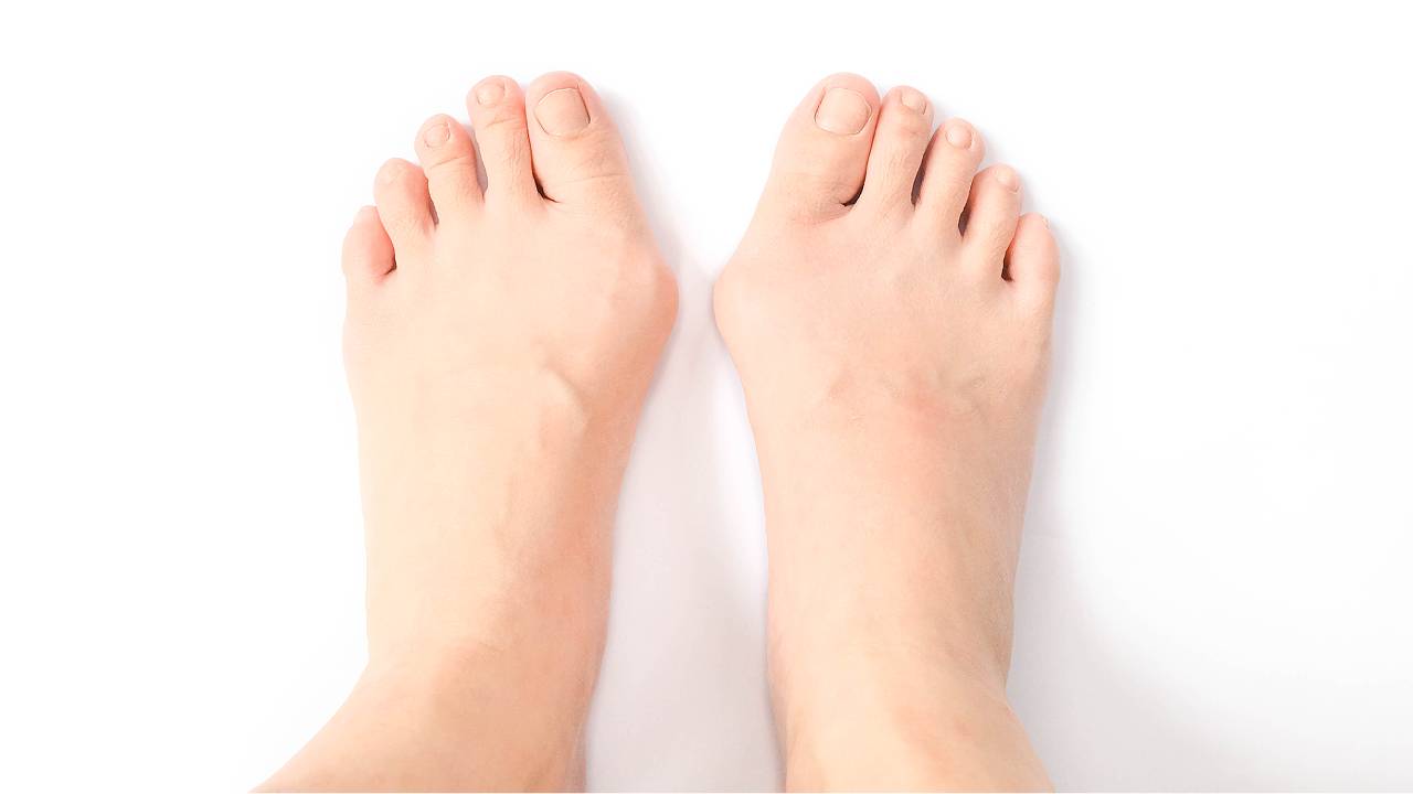 Tanda dan gejala Bunion Juvana. Straits Podiatry