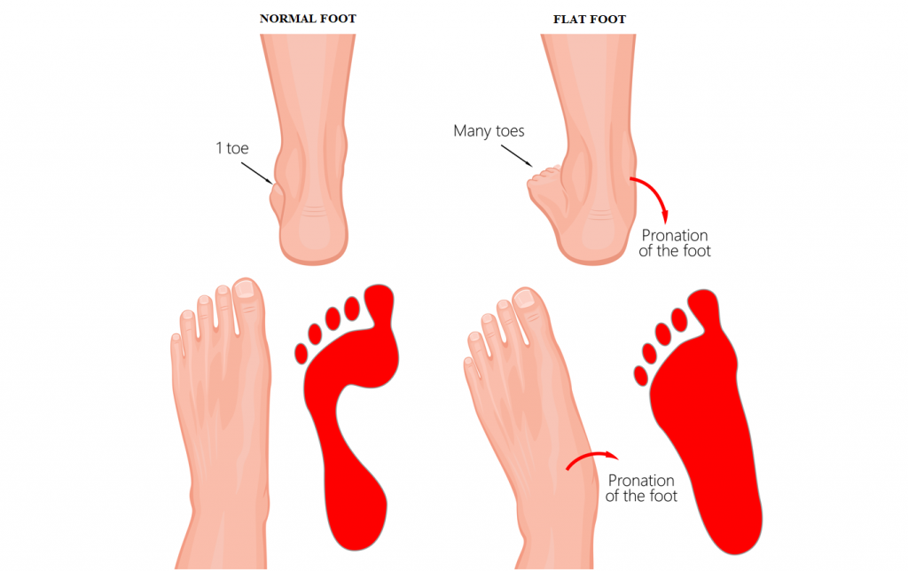 Paediatric Flat Feet | Signs, Symptoms, Treatment - Straits Podiatry