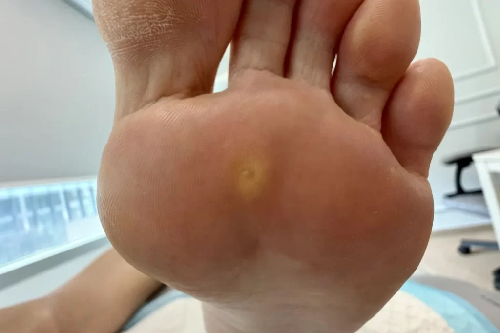 Painful corn under the left foot.