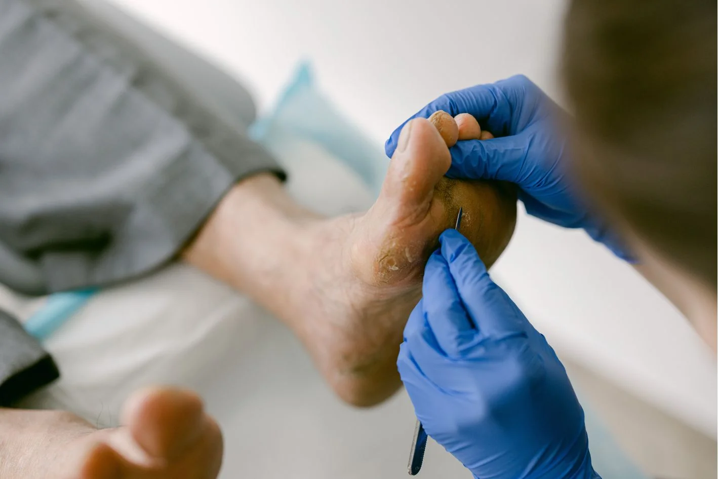 foot corn removal by podiatrist at Straits Podiatry