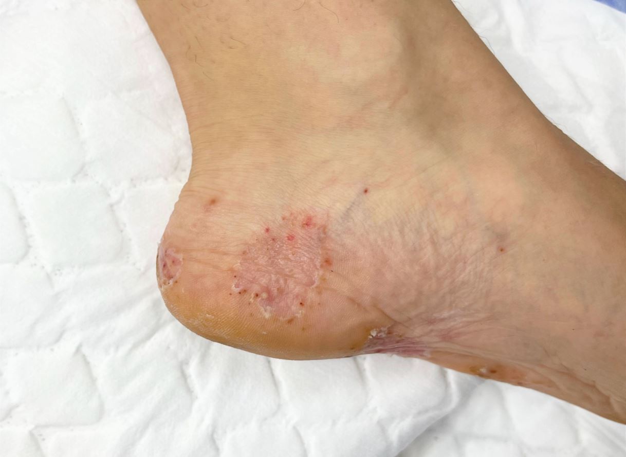 Tanda dan gejala kulit kulat. Straits Podiatry Singapura