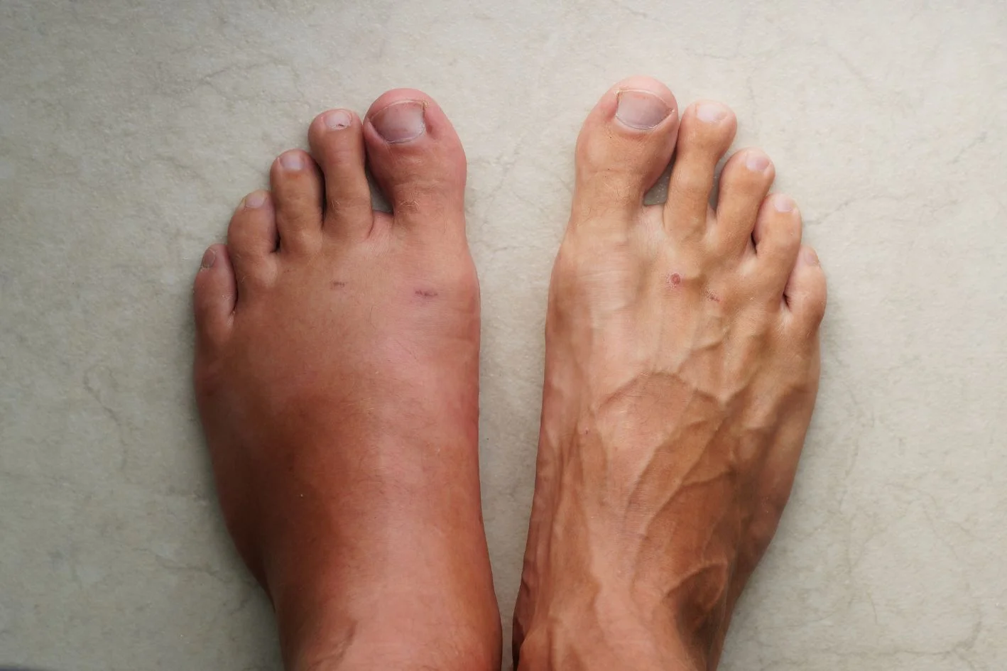 Gout affecting the midfoot joints, causing foot pain.