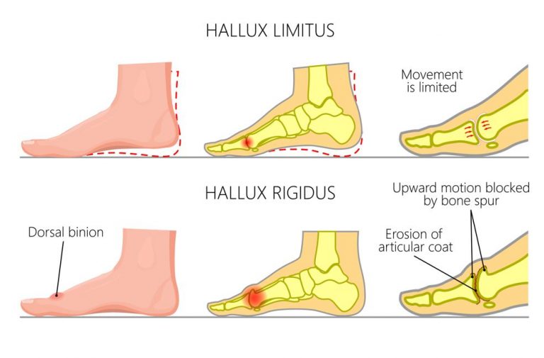 Hallux Rigidus Causes & Treatment Singapore Straits Podiatry